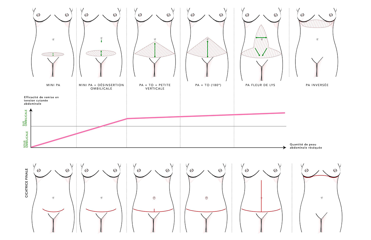 Schéma résumant les principaux types de plasties abdominales