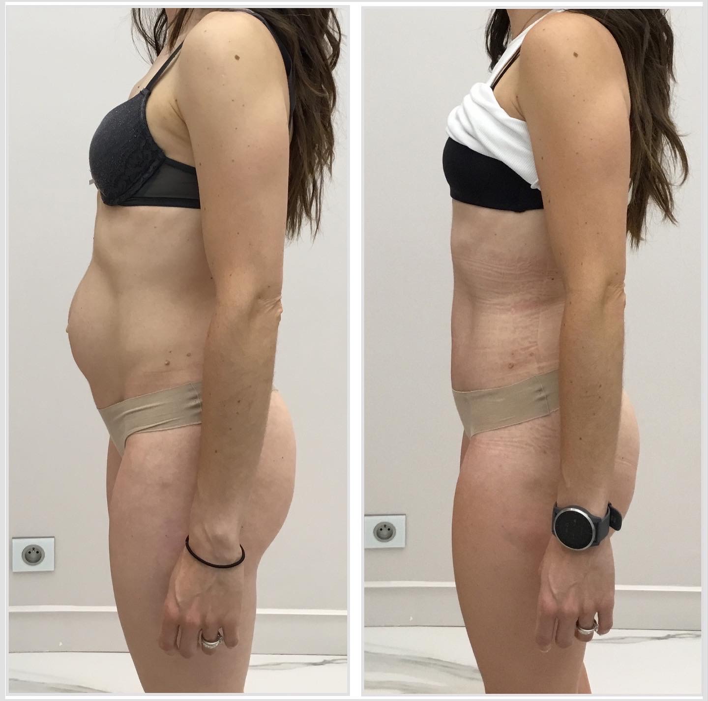 Abdominoplastie avec transposition de l’ombilic et cure de diastasis