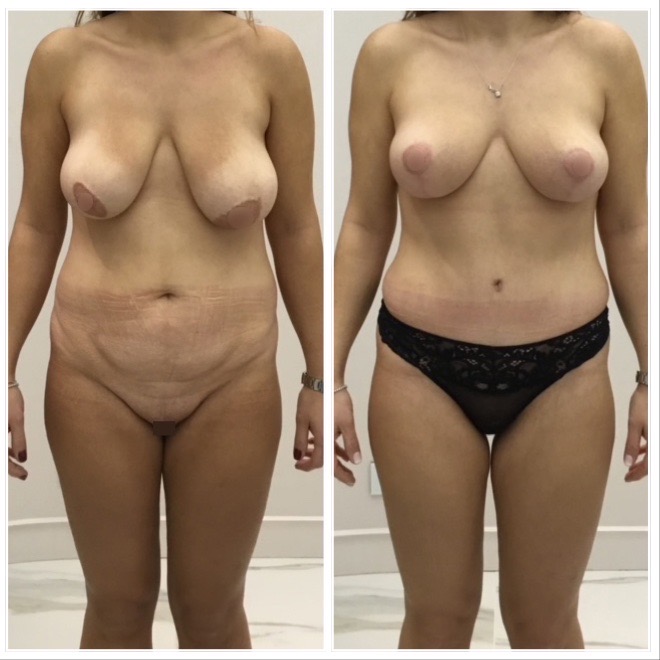 Abdominoplastie avant apres avec transposition de lombilic associee a un lifting des seins cure de ptose mammaire vue face