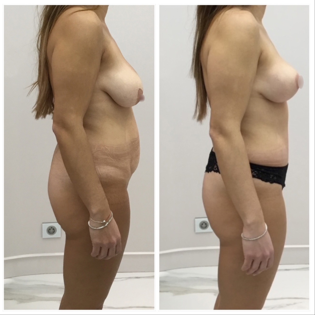 Abdominoplastie avant apres avec transposition de lombilic associee a un lifting des seins cure de ptose mammaire vue profil droit