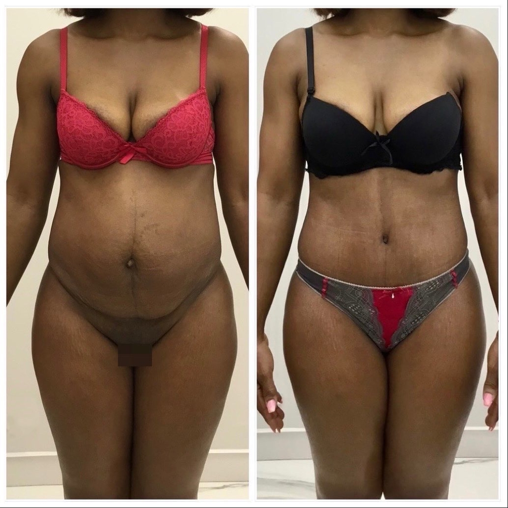 Abdominoplastie cure de diastasis post grossesse vue de face