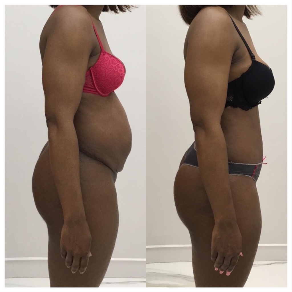 Abdominoplastie cure de diastasis post grossesse vue de profil