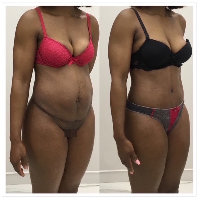 Abdominoplastie cure de diastasis vue de 3 quarts bis