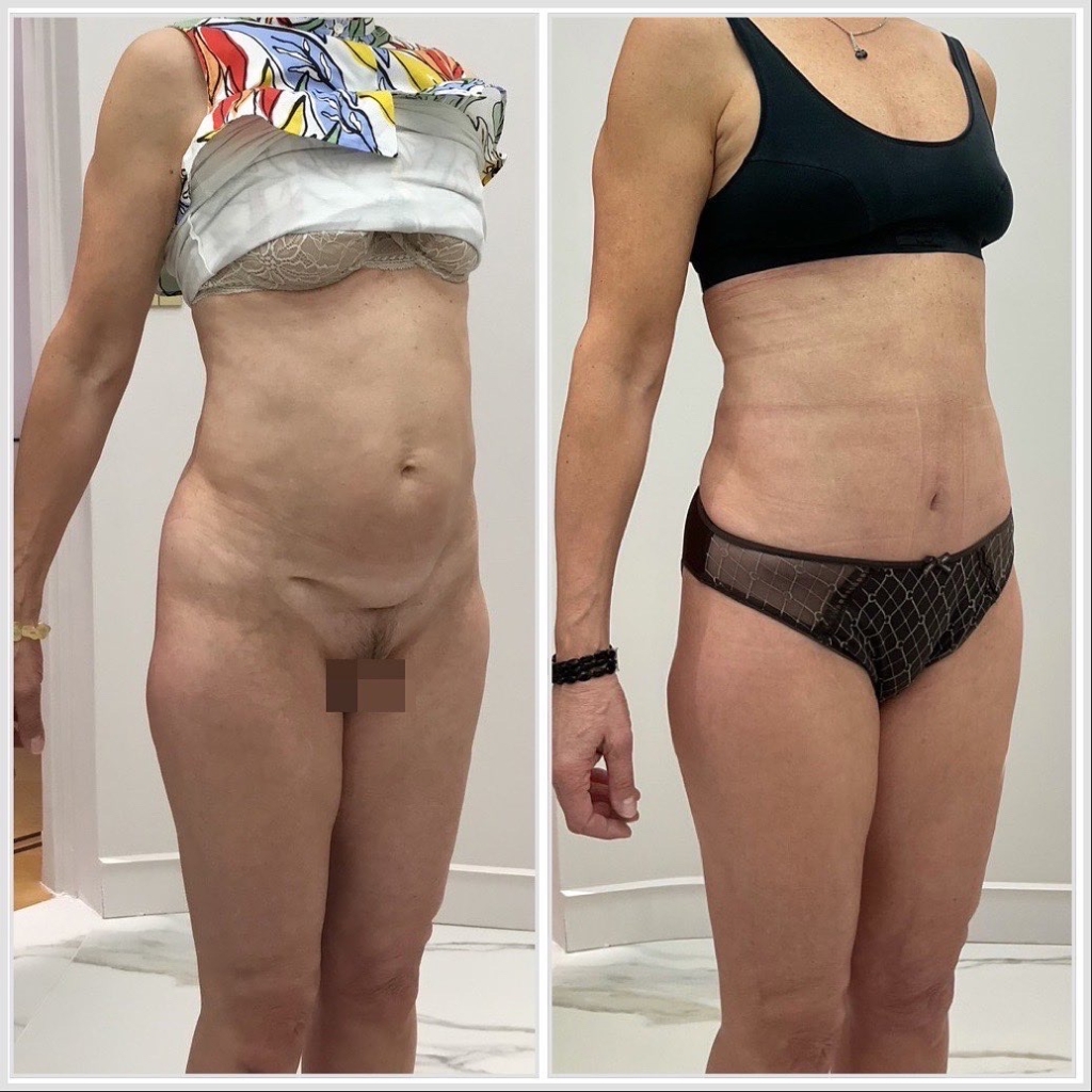 Mini plastie abdominale avec désinsertion de l’ombilic et cure de diastasis - vue de 3 quarts