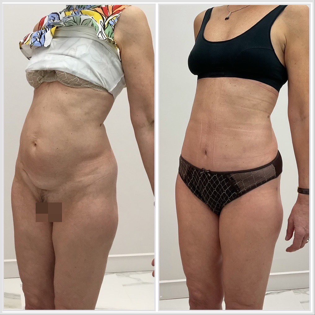 Mini plastie abdominale avec désinsertion de l’ombilic et cure de diastasis - vue de 3 quarts bis