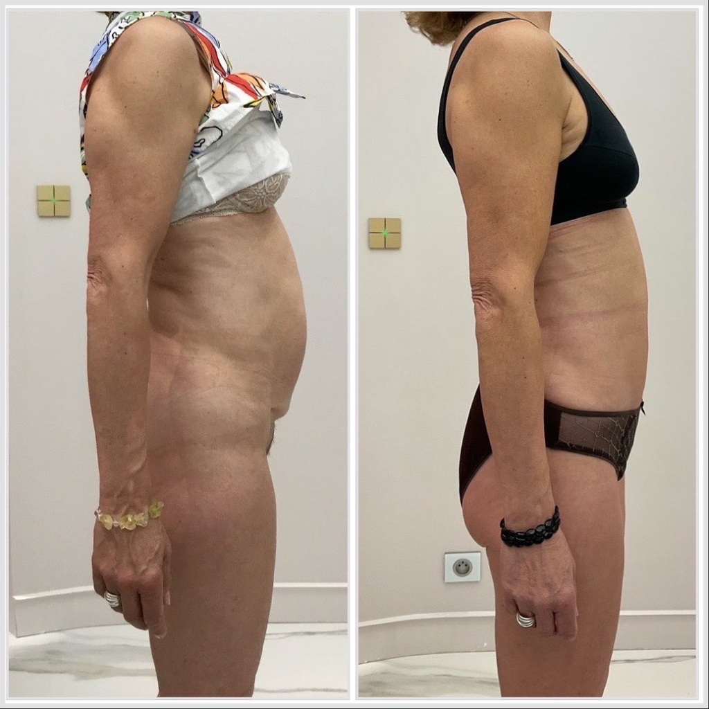 Mini plastie abdominale avec désinsertion de l’ombilic et cure de diastasis - vue de profil