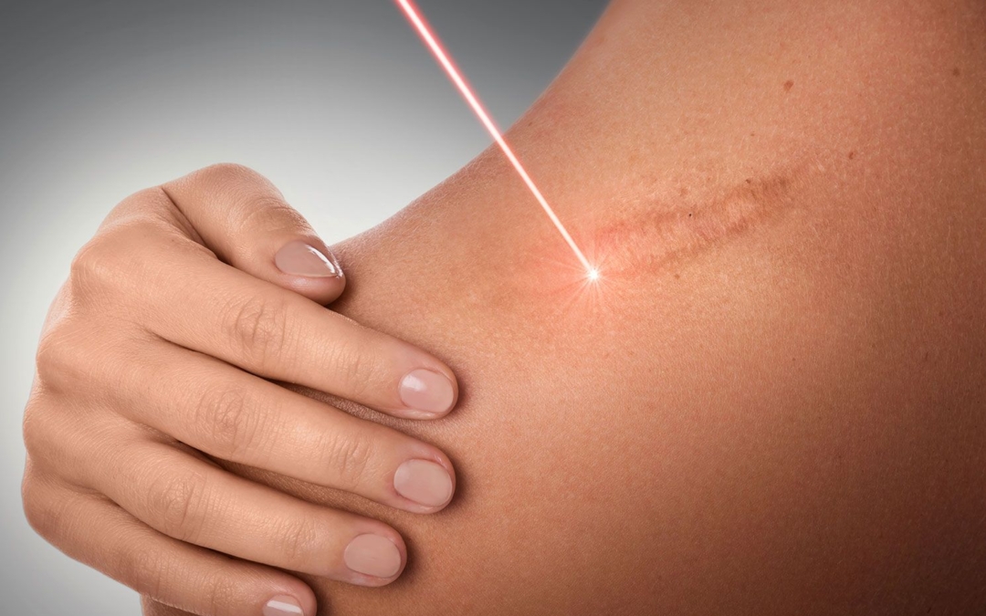 UrgoTouch : un laser spécifique qui permet d’influer sur le résultat cicatriciel