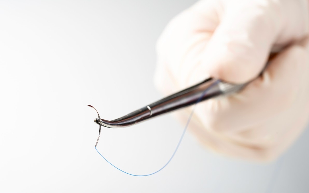 Le surjet spiralé : un nouveau concept de suture cutanée en chirurgie esthétique de la silhouette pour optimiser la cicatrisation