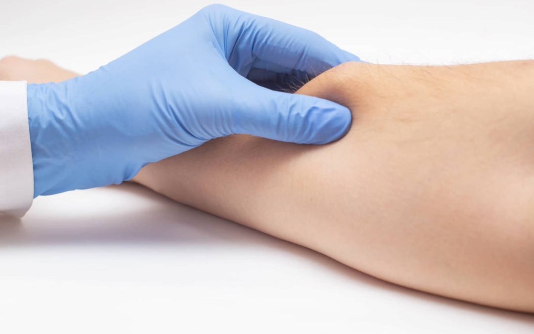 Le lipome (corps & cuir chevelu) est-il un cancer ?